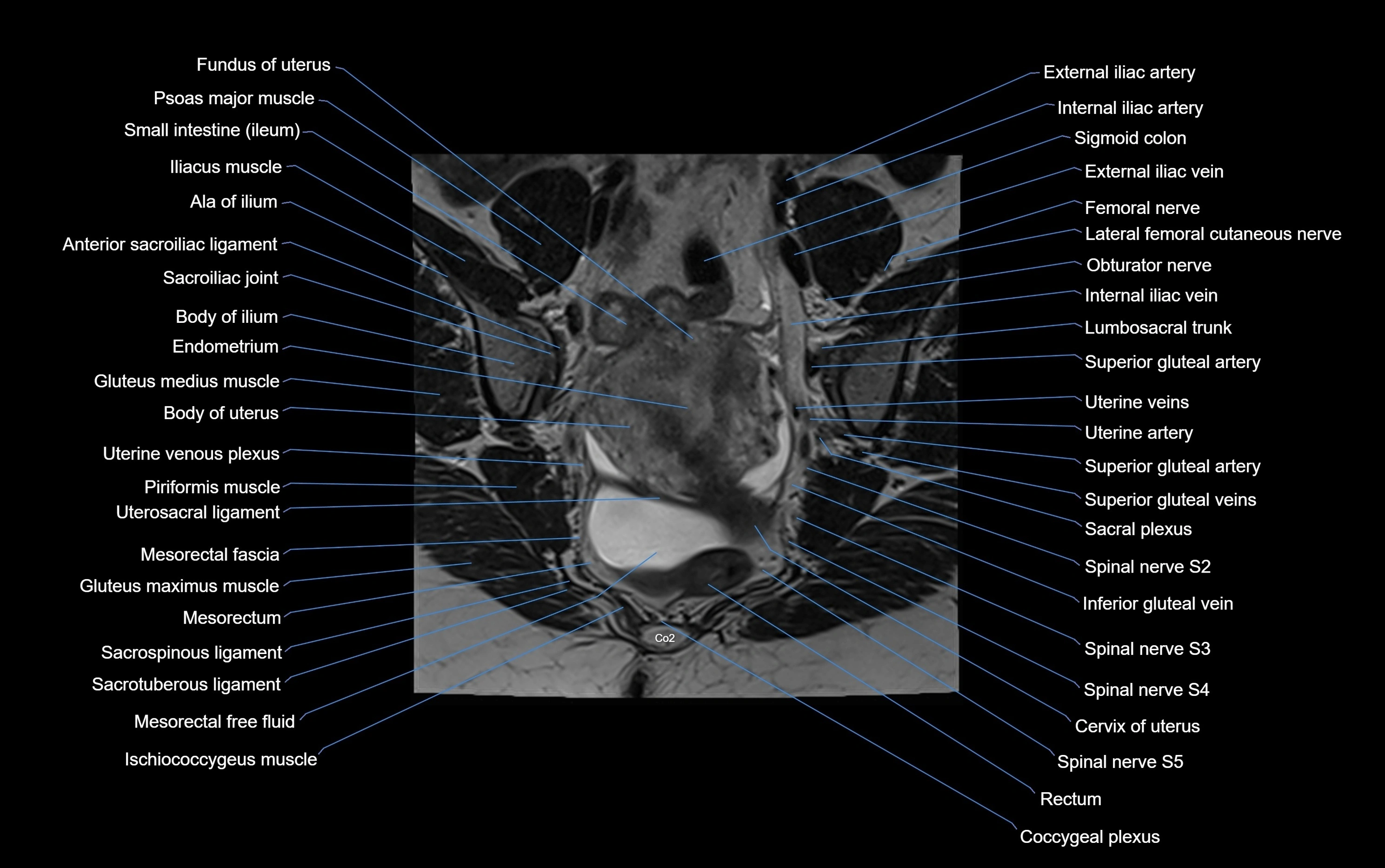 MRI sacroiliac joint coronal cross sectional anatomy  radiology  image-img-00001-00007.webp